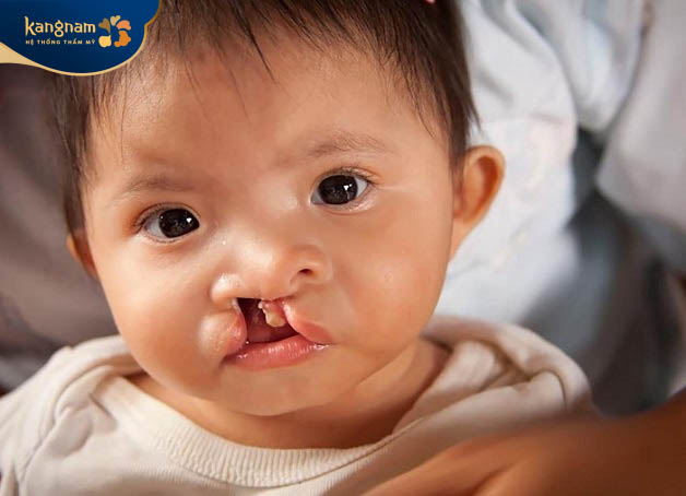 Sứt môi và hở hàm ếch là tình trạng các mô của miệng, môi không hình thành trong quá trình thai nhi phát triển trong bụng mẹ