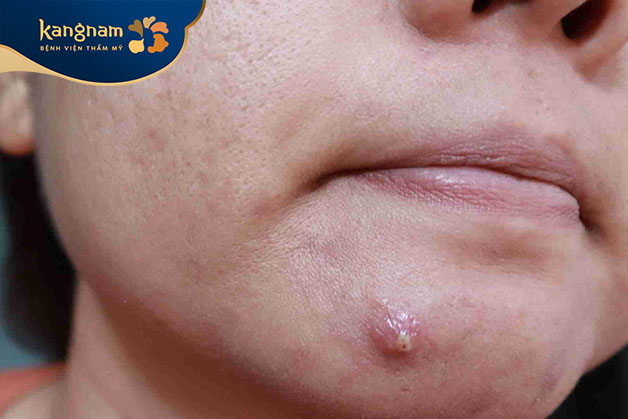 Mụn bọc ở cằm