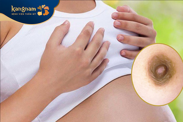 Nguyên nhân chủ yếu gây đau nhức khi thu nhỏ nhũ hoa bị đau do tay nghề bác sĩ