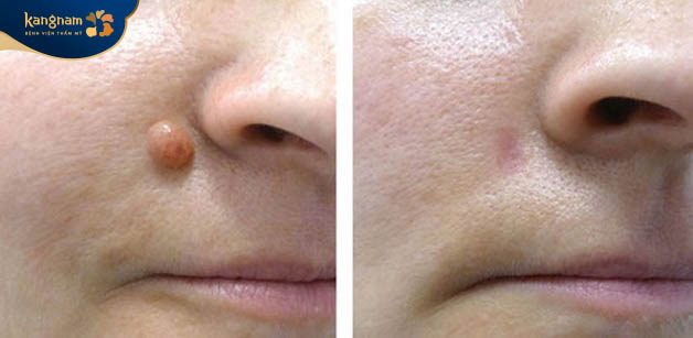 Tẩy nốt ruồi giúp tăng tính thẩm mỹ