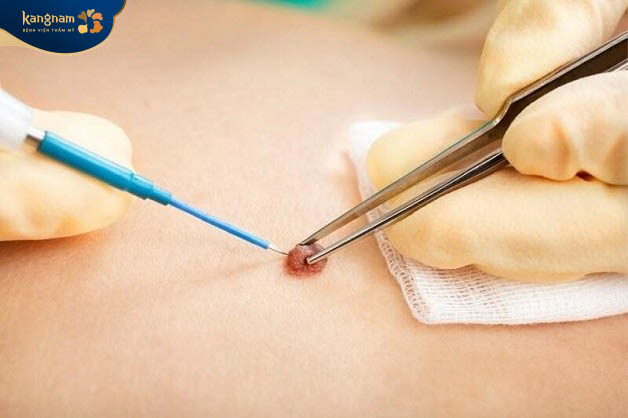 Phương pháp cắt nốt ruồi cần thực hiện tại cơ sở chuyên khoa