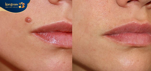 Kết quả sau khi xóa bỏ nốt ruồi tại Kangnam