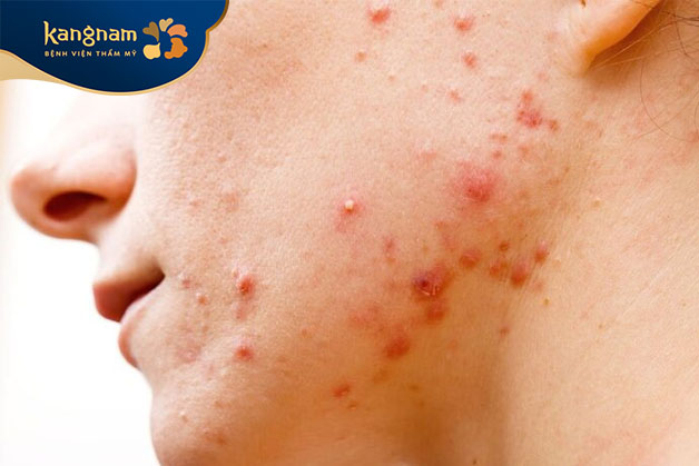 Mụn bọc ở cổ