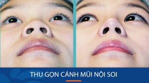 Thu gọn cánh mũi nội soi – Tạo hình mũi thon gọn, cân đối