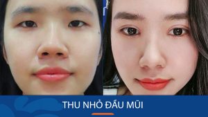 Cách thu nhỏ đầu mũi hiệu quả: Hướng dẫn và lời khuyên từ chuyên gia