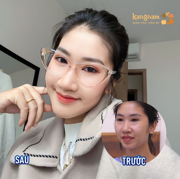 Tiêm Filler để giúp cằm dài và có độ nhô ra phía trước, khắc phục dáng cằm bị lẹm