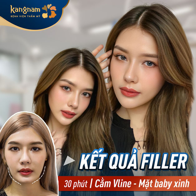 Tiêm filler an toàn, chính xác và tự nhiên