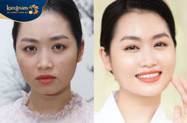 Tiêm meso dưỡng da trắng sáng