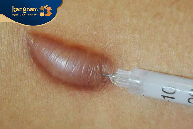 Tiêm thuốc để điều trị sẹo lồi thường sử dụng các loại thuốc corticosteroid