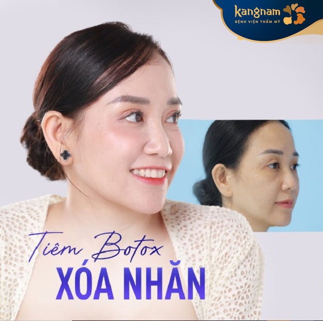 Phương pháp tiêm botox xóa nhăn