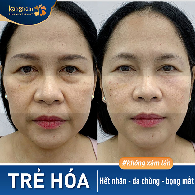 Trẻ hóa da xóa bỏ nếp nhăn, lấy lại nét xuân