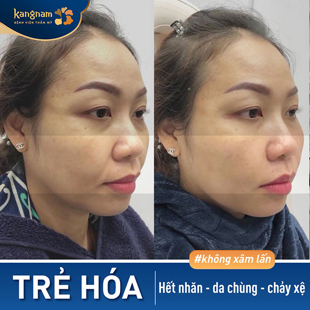 Trẻ hóa da giúp chị khách lấy lại thêm 5 tuổi xuân