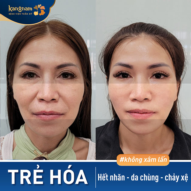 Xóa nhăn toàn gương mặt, mang lại nét trẻ trung