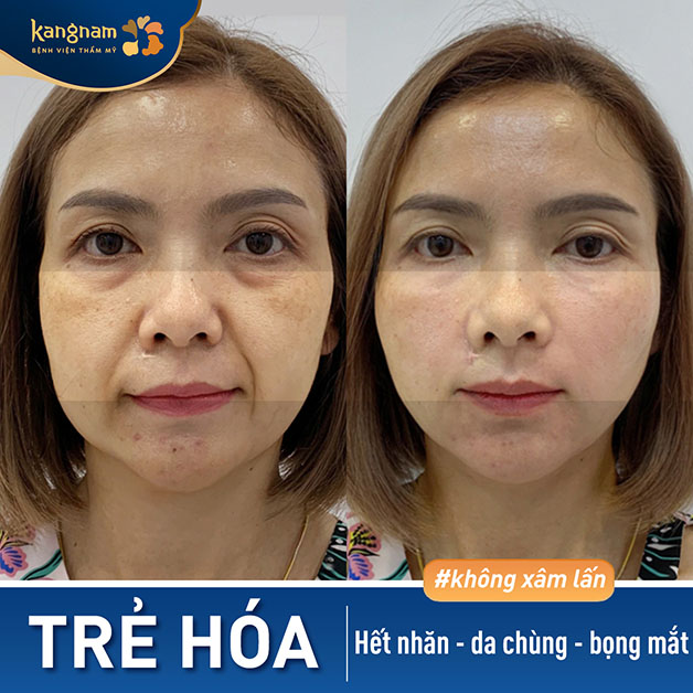 Kangnam là địa chỉ căng da trẻ hóa hiệu quả và uy tín