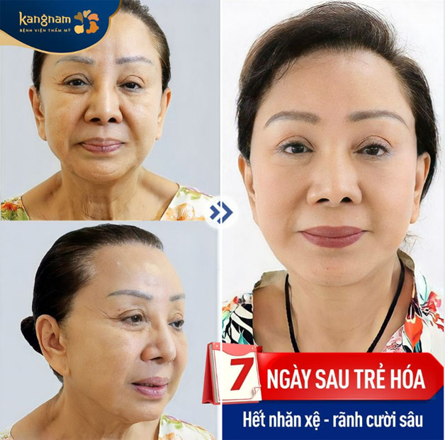 Khách hàng trẻ hóa sau 7 ngày, da hết nhăn, hết chảy xệ