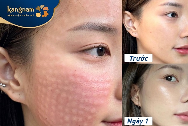 Trẻ hóa da bằng liệu pháp tiêm meso