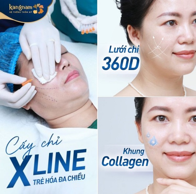 Công nghệ căng chỉ Xline trẻ hóa toàn diện