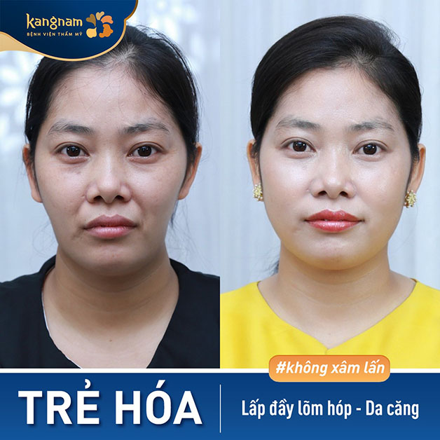 Hết chảy xệ, hết nhăn, mang lại vẻ tươi sáng cho gương mặt