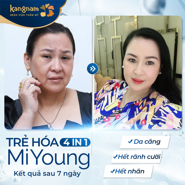 Da căng bóng, hết rãnh cười, hết nếp nhăn