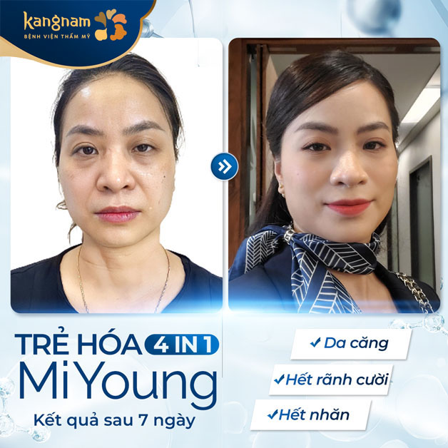 Chị em phụ nữ lấy lại tuổi xuân sau khi căng chỉ trẻ hóa