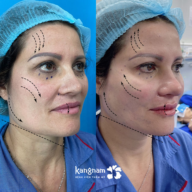 Kết quả trẻ hóa da tự nhiên tại Kangnam