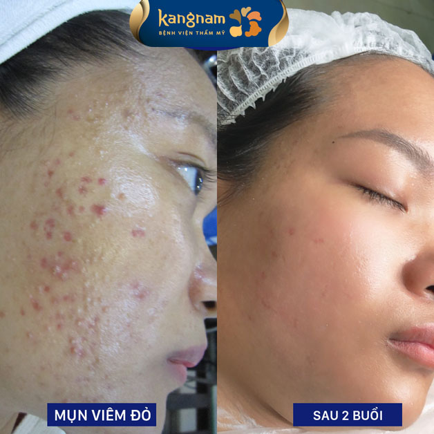 Xóa bỏ mụn bọc, mụn viêm toàn mặt hiệu quả