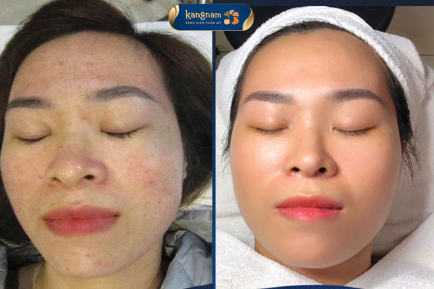 Trị mụn De-Acne sạch mụn, hết thâm sau 1 liệu trình