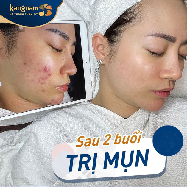 Xóa sổ mụn bọc, mụn viêm toàn mặt