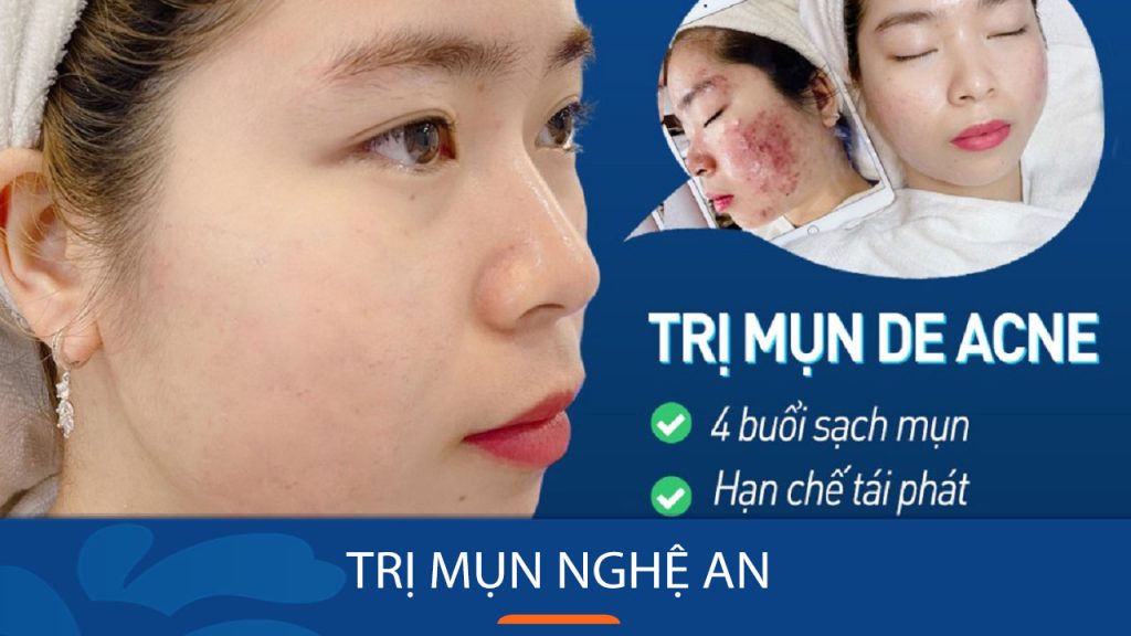 Viện Thẩm mỹ Kangnam Nghệ An – Địa chỉ trị mụn Nghệ An uy tín, chất lượng!