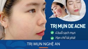 Viện Thẩm mỹ Kangnam Nghệ An – Địa chỉ trị mụn Nghệ An uy tín, chất lượng!