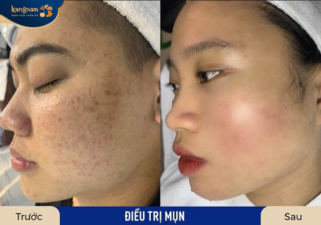 Nguyễn Minh rất hài lòng với kết quả trị mụn