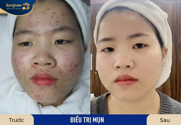 Sau vài buổi trị mụn làn da sạch mụn và ngăn ngừa mụn mọc lại tối ưu nhất