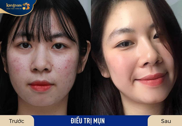 Làn da của Quỳnh sau khi trị mụn tại Kangnam