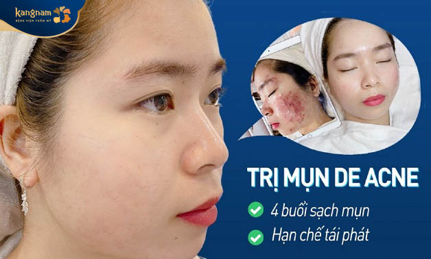 Công nghệ trị mụn De-Acne hiệu quả cao