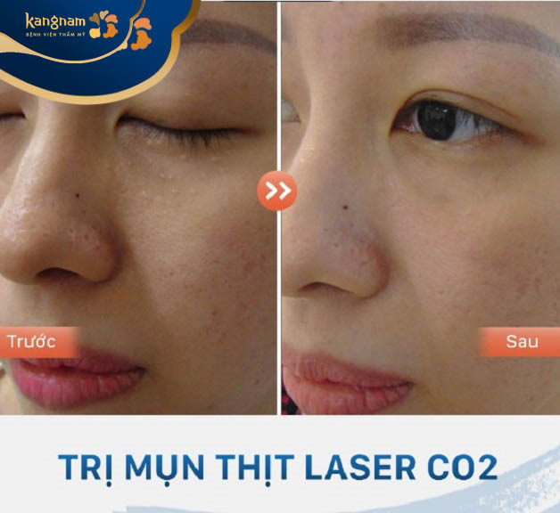 Bạn Trần My đã loại bỏ được mụn thịt dưới mắt hoàn toàn