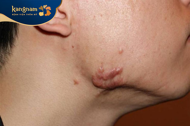 Phụ nữ mang thai hoặc đang cho con bú thường không được phép sử dụng Laser CO2