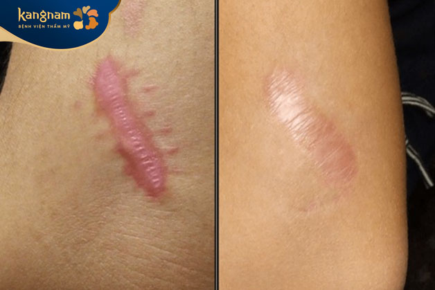 Xóa sẹo nhanh chóng, làn da mịn màng hơn sau điều trị