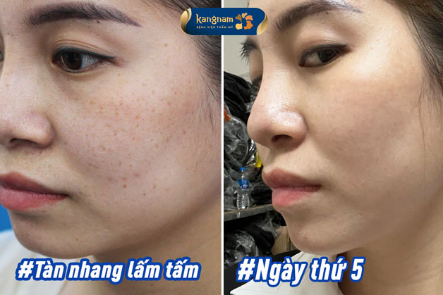 Xóa bỏ tàn nhang lấm tấm, chi phí phù hợp