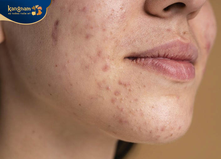 Thâm mụn là các tổn thương sau mụn