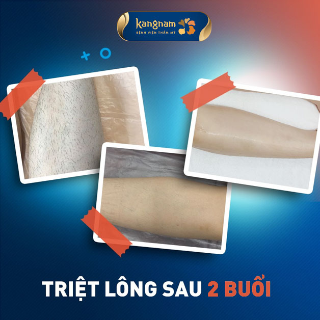 Lông giảm dần và thưa hơn sau 2 buổi triệt lông
