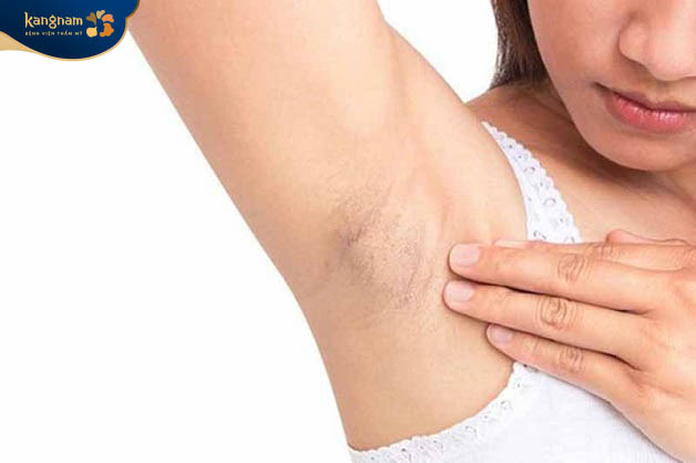 Triệt lông nách sở hữu những ưu và nhược điểm riêng