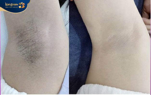 Thu Linh rất hài lòng sau khi triệt lông nách