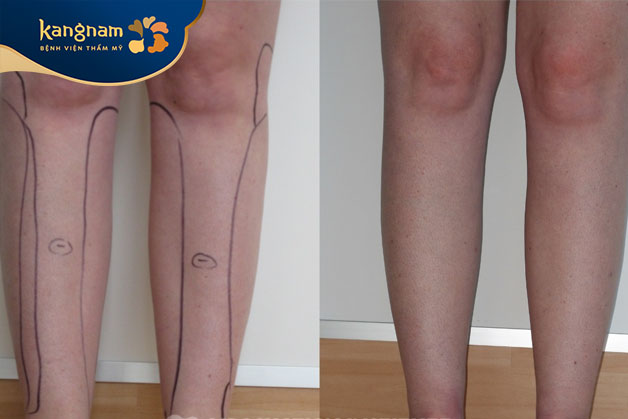 Giảm mỡ bắp chân nhanh chóng tại Kangnam