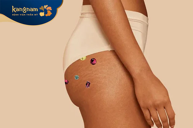 Vệ sinh da mông chưa kỹ gây mụn