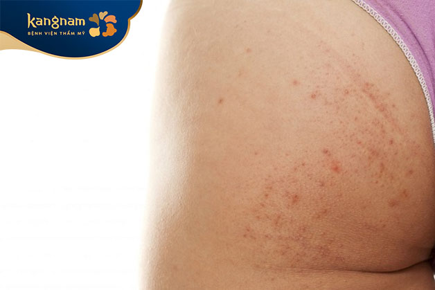 Mụn trứng cá ở mông