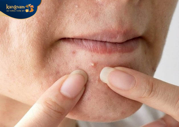 Nặn mụn không đúng cách cũng là một trong những nguyên nhân chính gây ra tình trạng sẹo rỗ