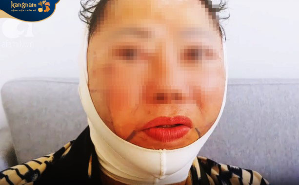 Biến chứng sau khi căng da mặt giá rẻ