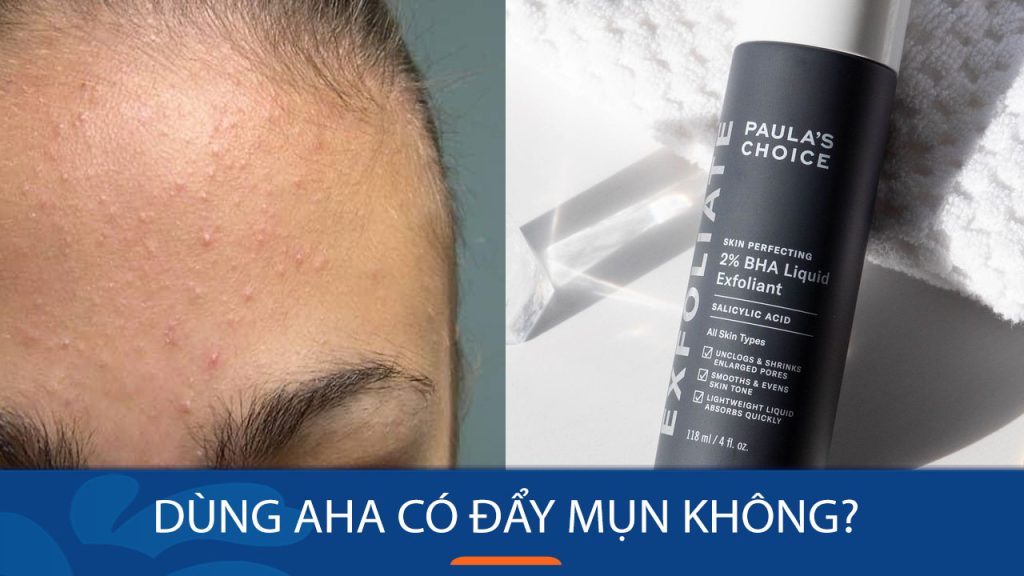 [Giải đáp] Dùng AHA có đẩy mụn không? Mụn ẩn “bùng nổ” sau khi dùng AHA là do đâu?