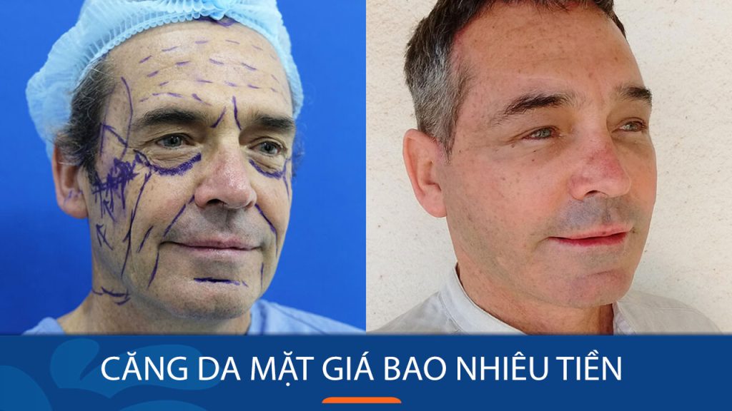 Căng da mặt giá bao nhiêu tiền? Những yếu tố ảnh hưởng