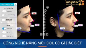 Giải mã sức hút của Nâng mũi Idol: Công nghệ nâng mũi tiên tiến bậc nhất hiện nay